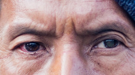 He had dense cataracts in both eyes and was offered surgery to both; he however insisted on only having one eye done...here the left eye can be seen to still have a whitish cataract whilst the right pupil is clear